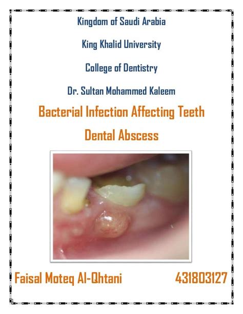 Bacterial Infection Affecting Teeth Dental Abscess