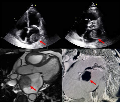 Figure 1 From Left Atrial Thrombus In The Setting Of Mitral Stenosis