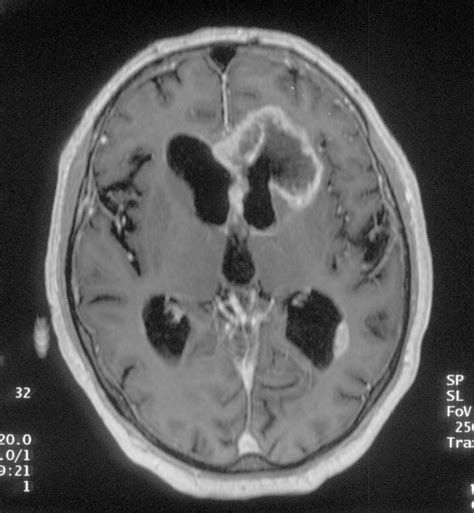 frontal lobe epilepsy alchetron   social encyclopedia