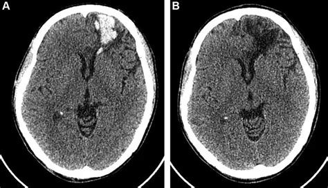 Rapid Absorption Of Frontal Lobe Contusion And Laceration Wi Medicine