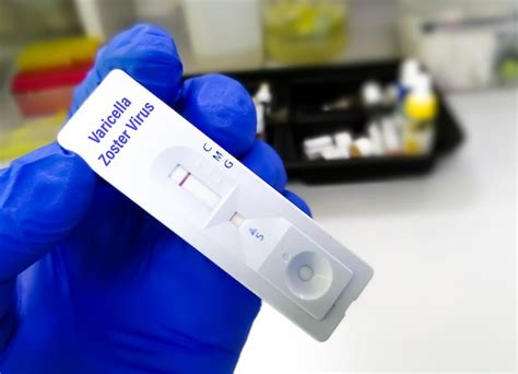 Dispositivo O Casete De Prueba R Pida Para El Virus De La Varicela