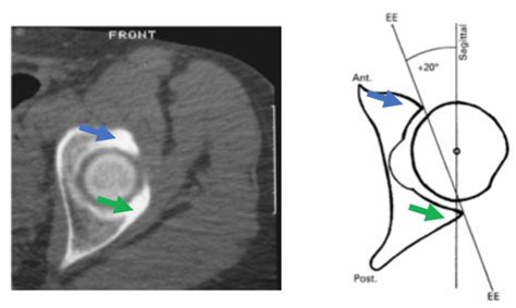 Acetabular Retroversion | David Slattery Orthopaedic Surgeon