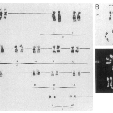 A G Banded Karyotype From Lymph Node Xy Inv Dup Q Q