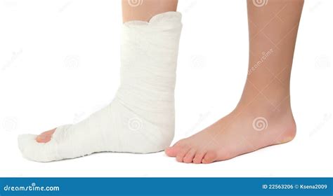 Leg In A Plaster Cast Royalty Free Stock Image - Image: 22563206