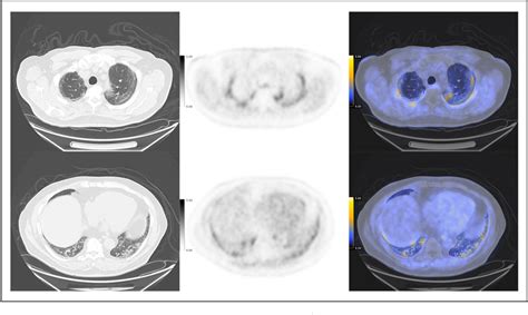 Pdf V Targeted Molecular Pet Ct Imaging Of The Lungs After Sars