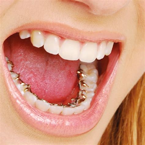 Aparelho Lingual Invisalign BH Clínica Rodrigo Almada