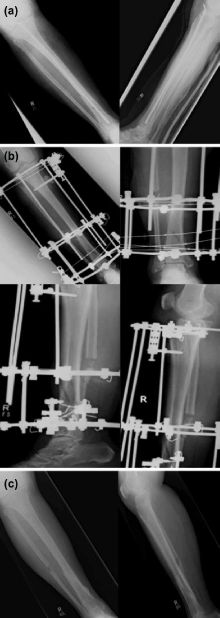 Radiographs Of Patient 2 A Pre Operative Anteroposterior And Lateral