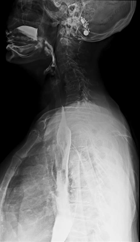 Achalasia Image Radiopaedia Org