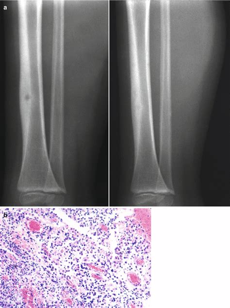 Osteomyelitis Musculoskeletal Key