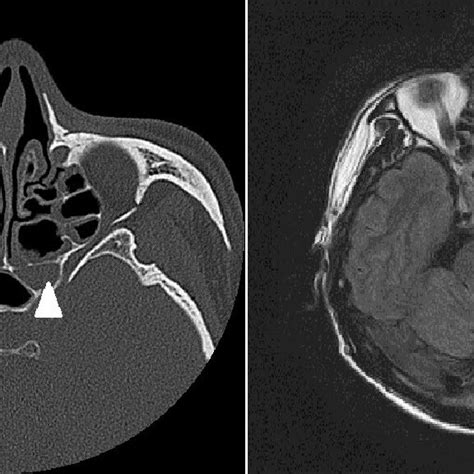 Preoperative Axial Computed Tomography Ct And Magnetic Resonance