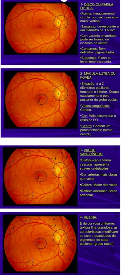 Resumo Fundoscopia Ham 2 Habilidades Médicas