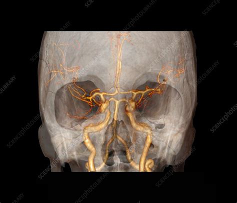 Circle Of Willis Diagram Ct Willis Cerebral Circulation Posterior