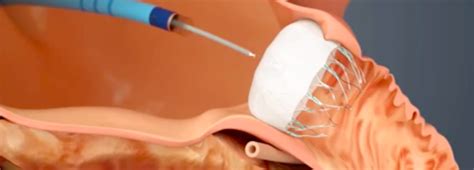 Stroke Prevention With Watchman Left Atrial Appendage Closure Device