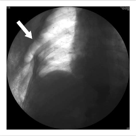 Upper Endoscopy Hiatal Hernia