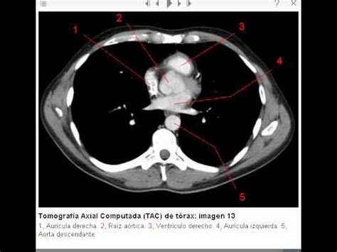 Tomografía Axial Computada TAC de tórax ventana mediastinal YouTube