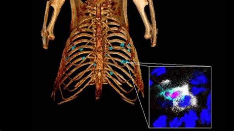 Mit Biologists Discover Key Step In Lung Cancer Evolution