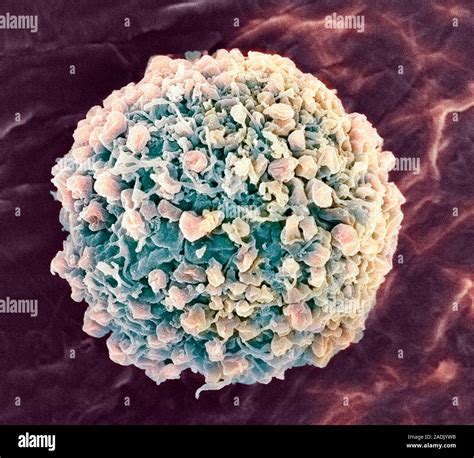 Cervical Cancer Cell Coloured Scanning Electron Micrograph Sem Of A