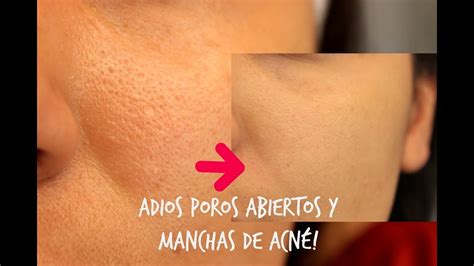 Cierra Los Poros Abiertos Y Manchas Por El AcnÉ Para Siempre Youtube