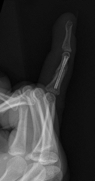 Nx Nail For Fixation Of A Comminuted Middle P2 Phalanx Fracture