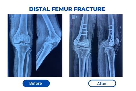 Fracture Plaster & Surgery - DR.SANJEED PUJARY