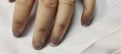 Acrocyanosis: Definition, Causes And Treatment