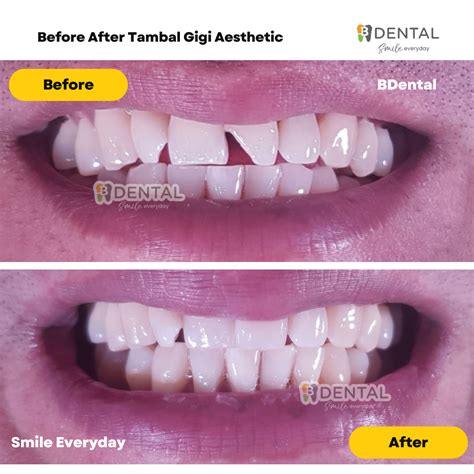 Before After – Tambal Gigi – Klinik BDental Malang