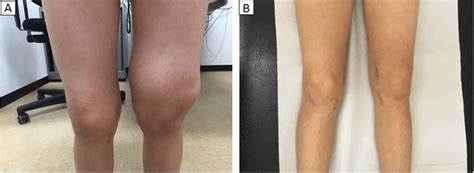 Clinical Photographs Showing Severe Swelling Of The Left Knee Joint At Download Scientific