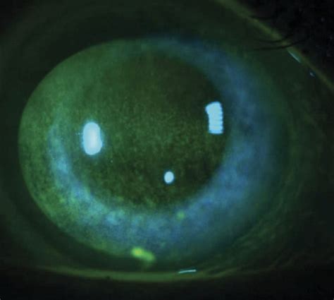 Diagnosing And Treating Neurotrophic Keratitis Review Of Presbyopia And The Aging Eye