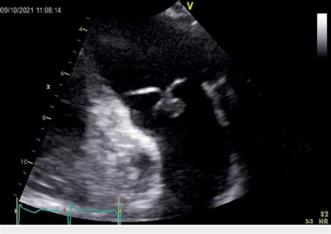 [pdf] Possible Isolated Pulmonic Valve Endocarditis In A Patient With Sickle Cell Disease A