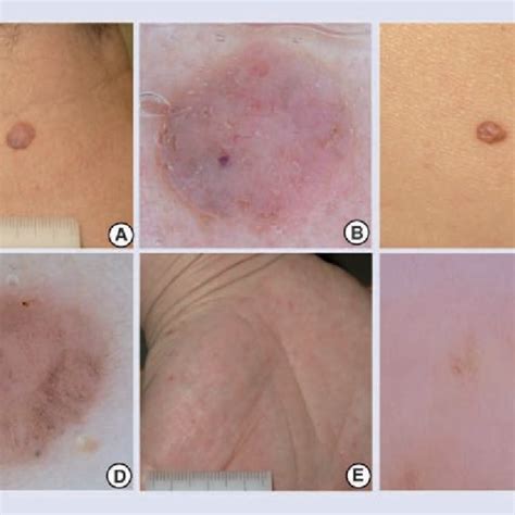 Dermoscopy Of Bowens Disease And Intraepidermal Carcinoma A