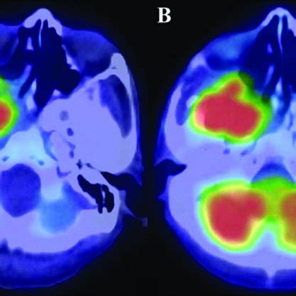 Positron Emission Tomography Scan Prior To Surgery Showing A High