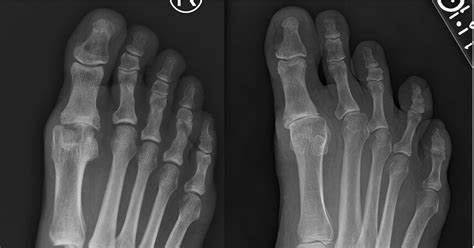 Arthritis Great Toe Hallux Rigidus — Chicago Foot And Ankle Orthopaedic Surgeons