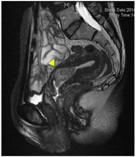 T2 Weighted Sagittal Mri Findings T2 Weighted Sagittal Mri Revealed