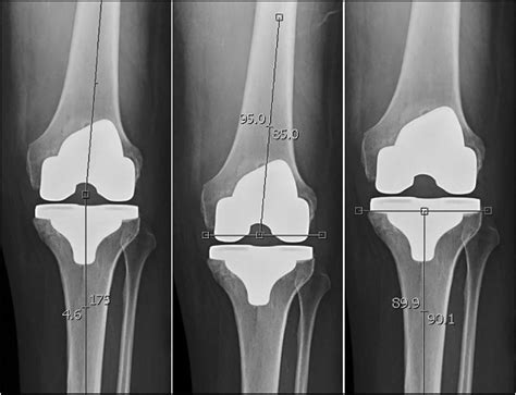 Effect Of Obesity On Component Alignment In Total Knee Arthroplasty Ochsner Journal