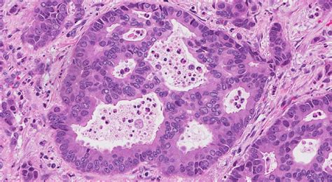 Adenocarcinoma Of The Lung Atlas Of Pathology