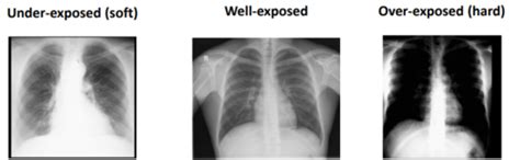 Understanding The Abnormal Chest X Ray Flashcards Quizlet