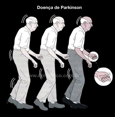 Treatment Of Parkinson S Disease