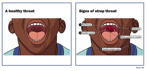 Tiny White Spots On Throat Not Strep