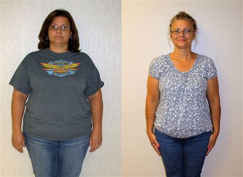 Sherrie S Weight Loss Transformation St Louis Bariatrics