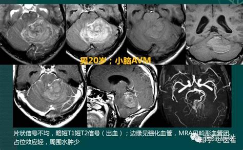 影像笔记 小脑半球肿瘤知多少？ 知乎