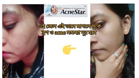 মখ বরণ এব বরণর দগ ও অযকন থক মকত Acnestar gel এর বযবহর