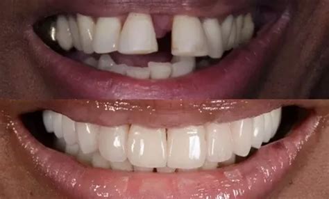 Smile Perfection Exploring The World Of Veneers With Removable Veneers