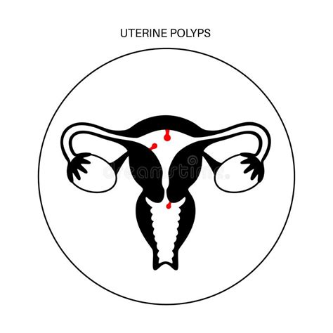 Hysteroscopy Of Uterus Womb Concept Vector Endometriosis Endometrium