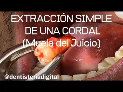 Extracci N Simple De Una Cordal Muela Del Juicio Youtube