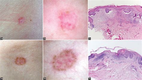 The Use Of Dermoscopy In Distinguishing The Histopathological Subtypes