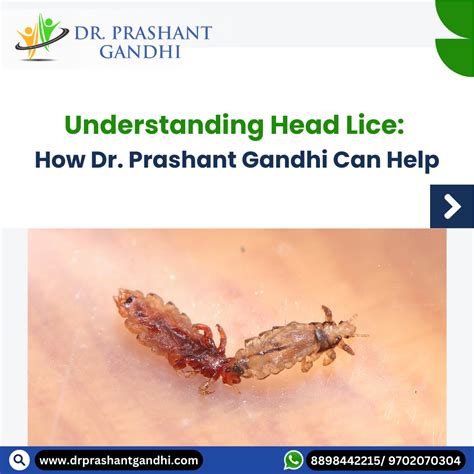 Understanding Head Lice Causes Symptoms And Treatment Best