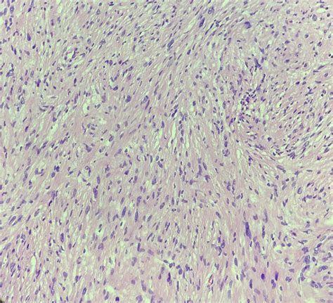 Peripheral Nerve Sheath Tumor Diagnosis R Pathology