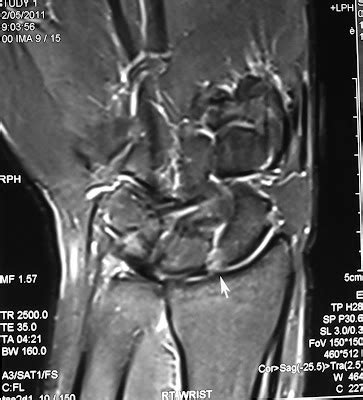 Radiodiagnosis - Imaging is Amazing-Interesting cases: Scapholunate ligament tear - MRI