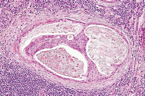 File Mucoepidermoid Carcinoma 2 High Mag Libre Pathology