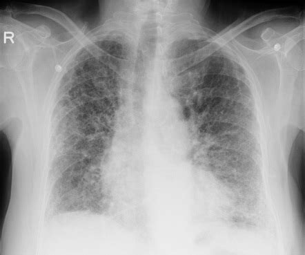 pulmonary fibrosis